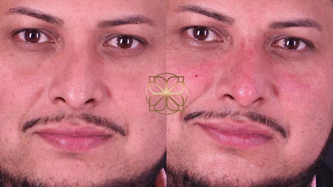 Injectables Gallery Before & After