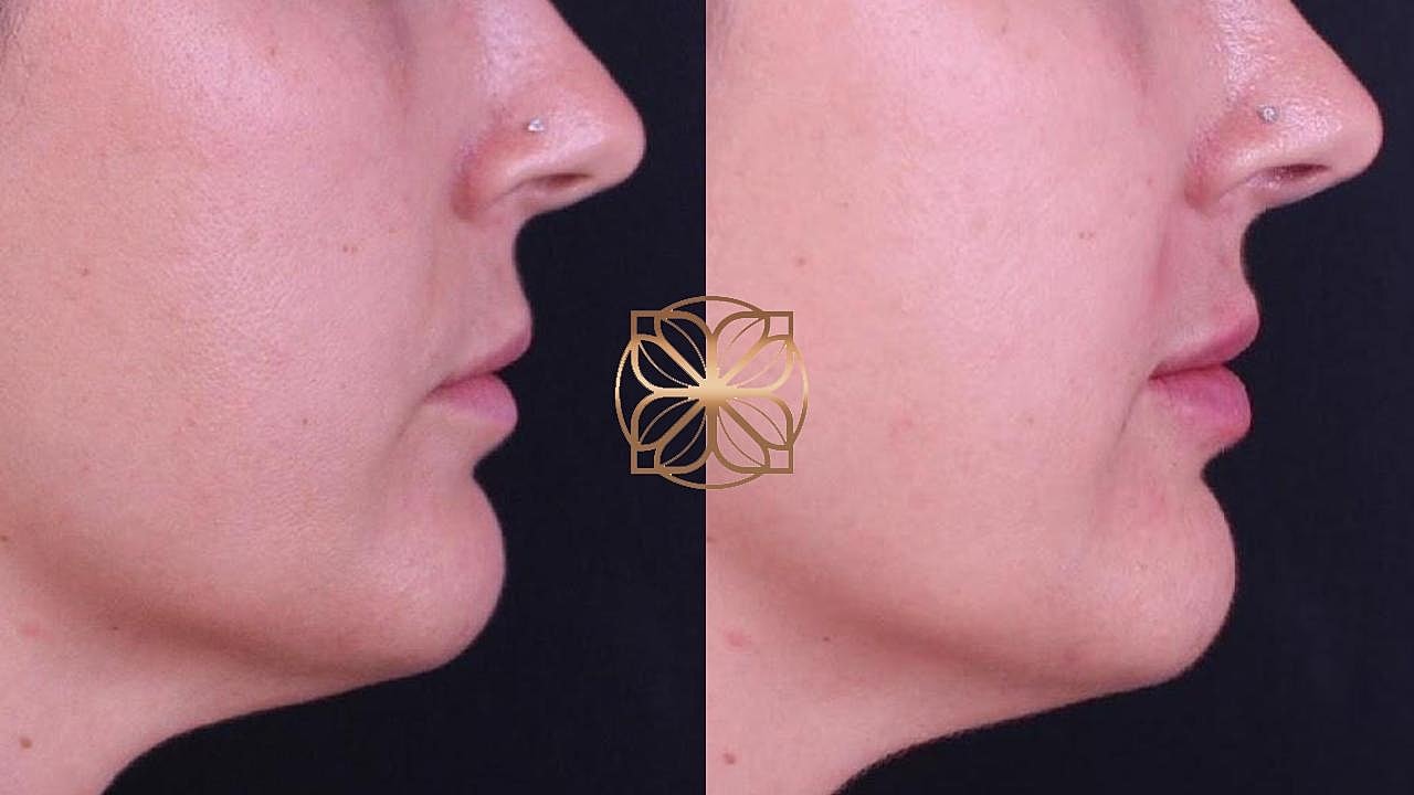 Injectables Gallery Before & After