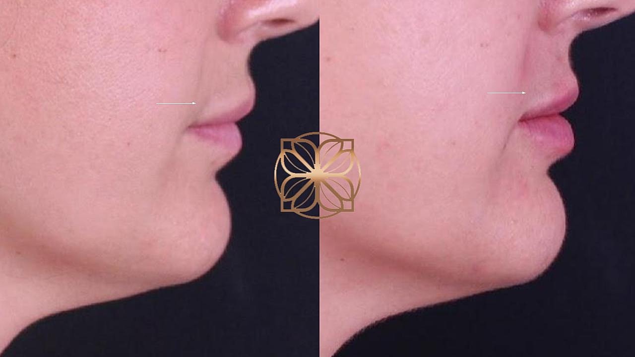 Injectables Gallery Before & After