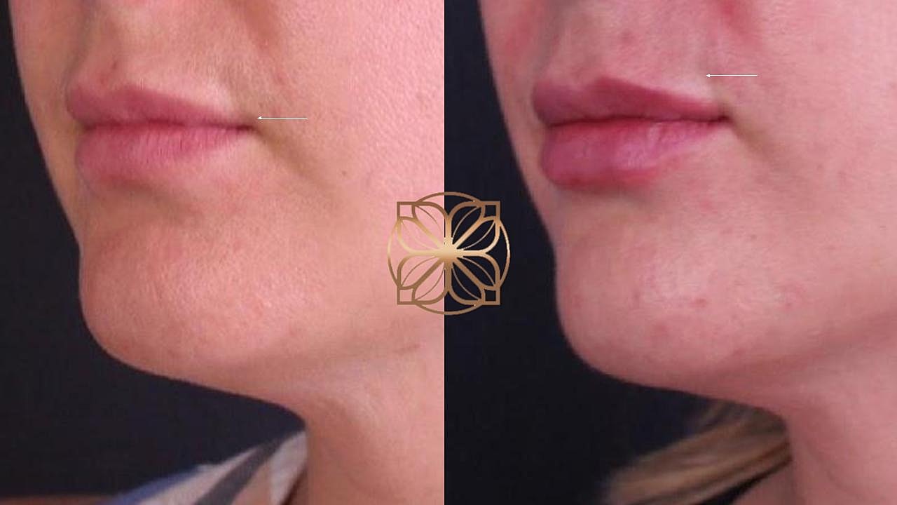 Injectables Gallery Before & After