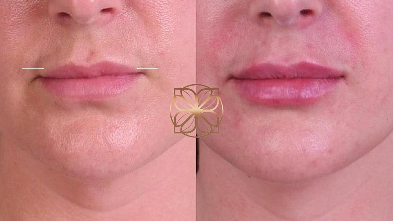 Injectables Gallery Before & After