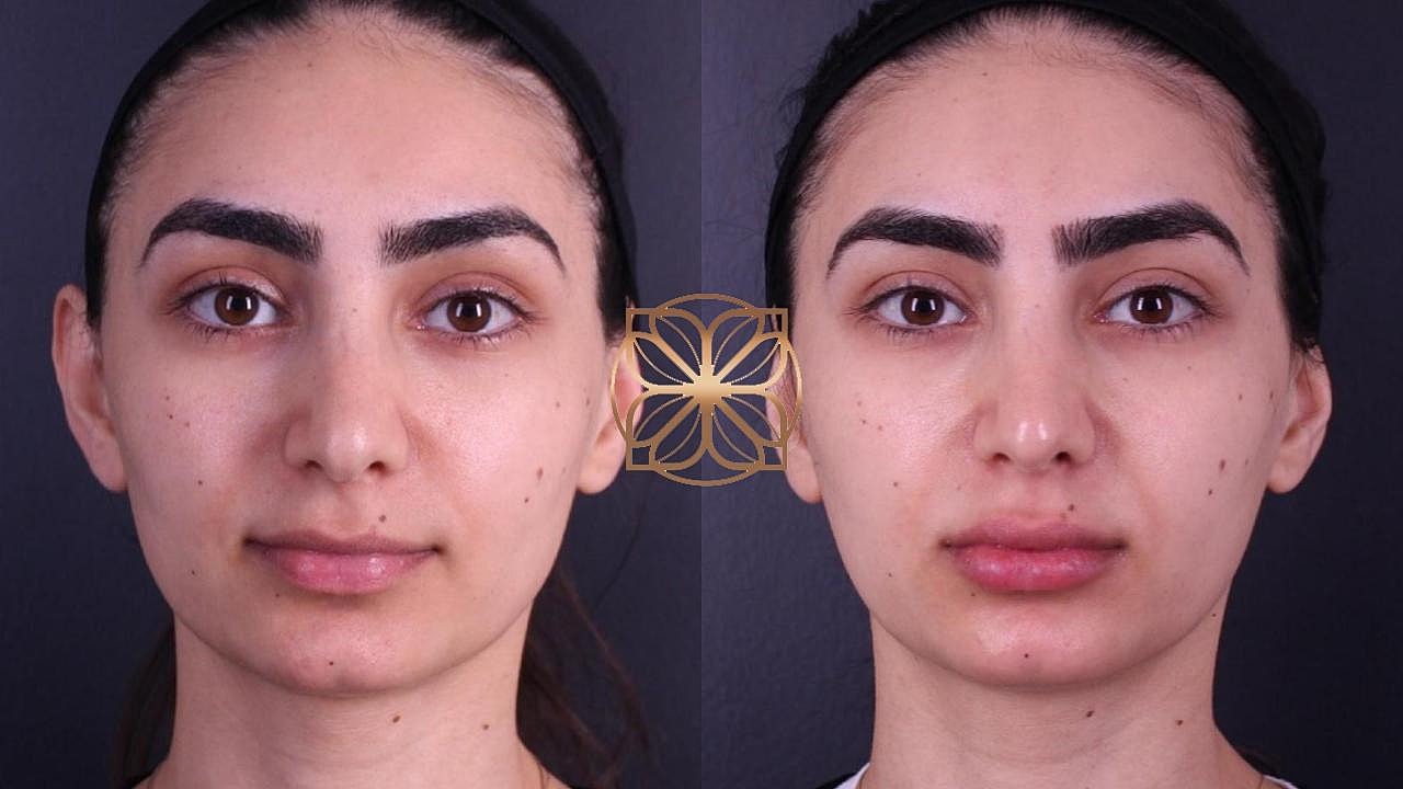 Injectables Gallery Before & After