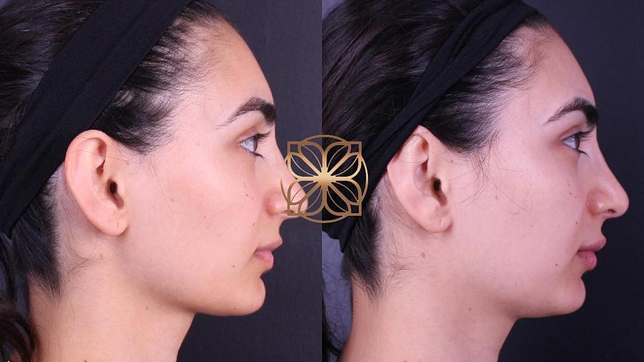 Injectables Gallery Before & After