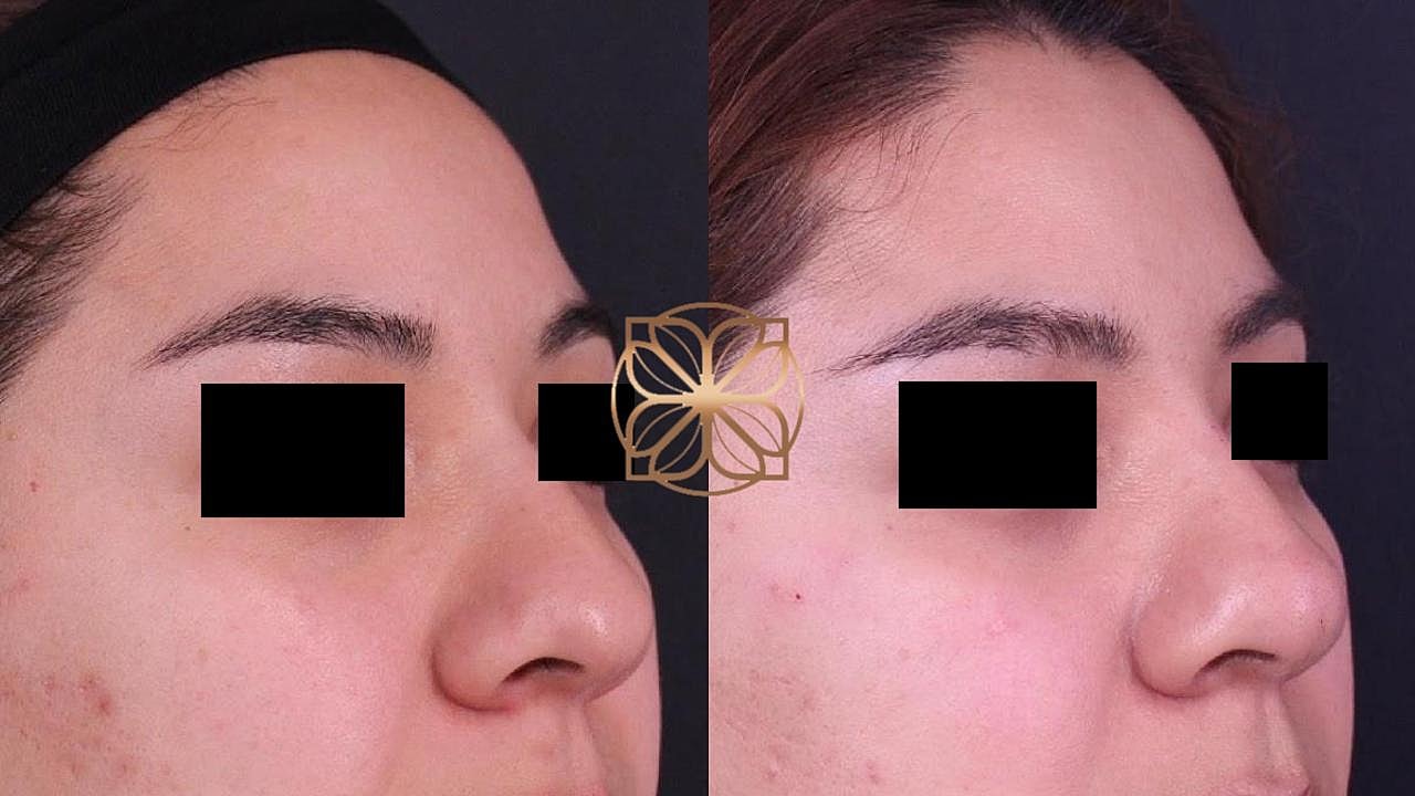 Injectables Gallery Before & After