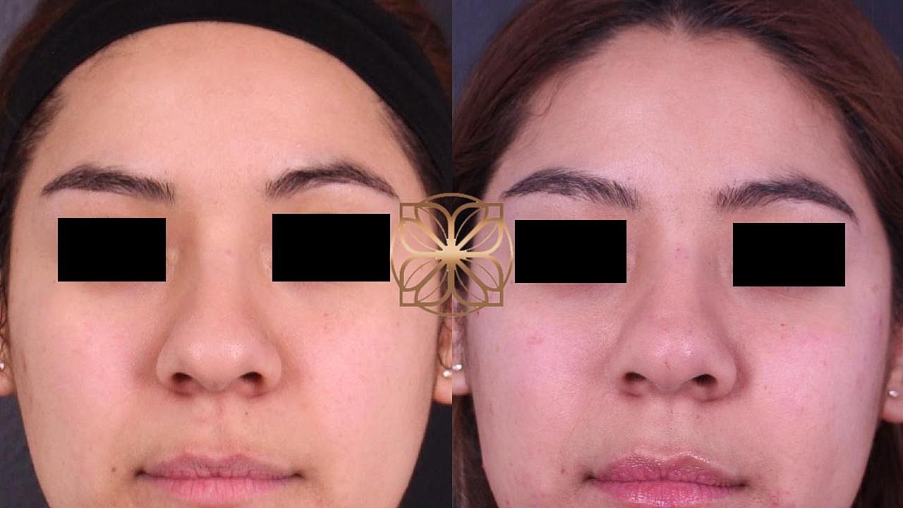 Injectables Gallery Before & After