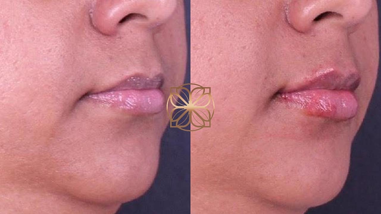 Injectables Gallery Before & After