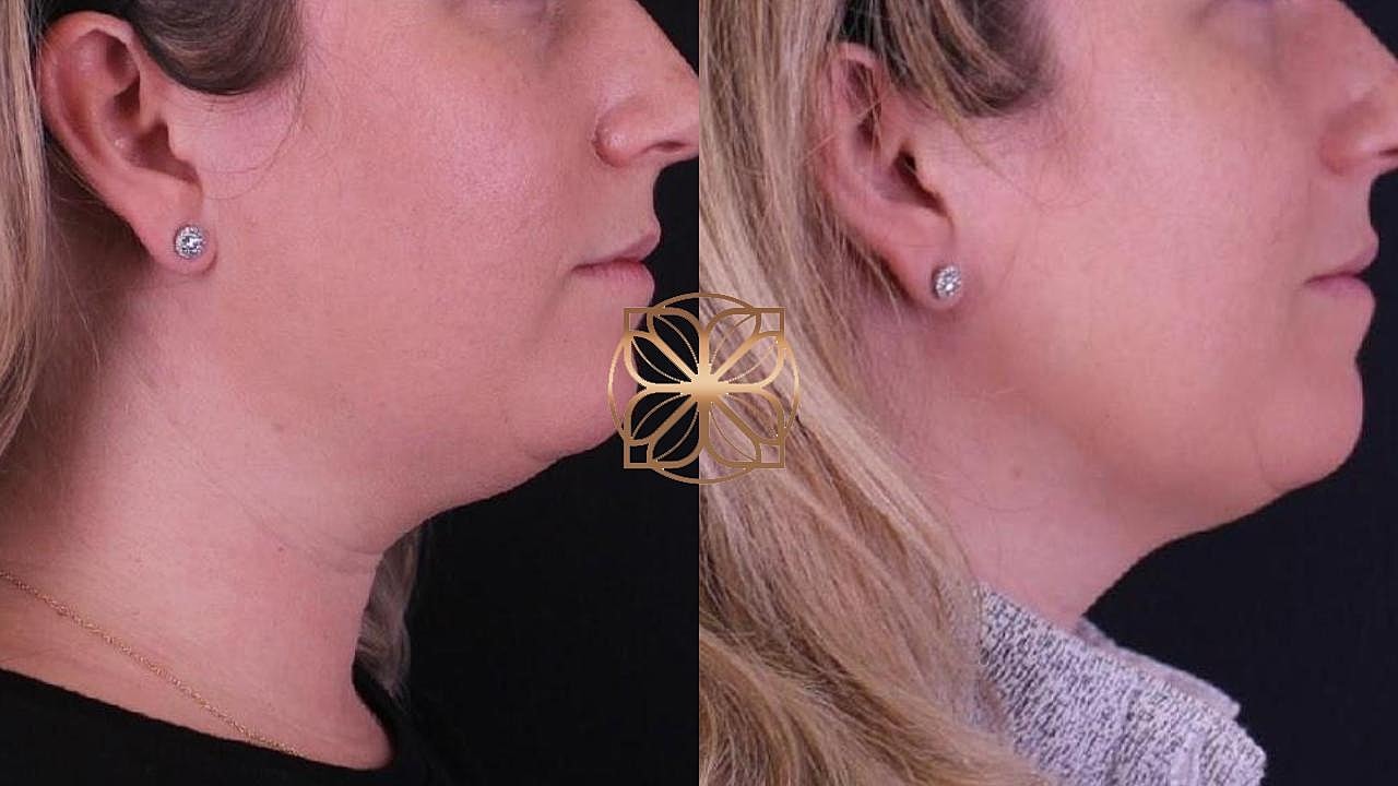 Injectables Gallery Before & After