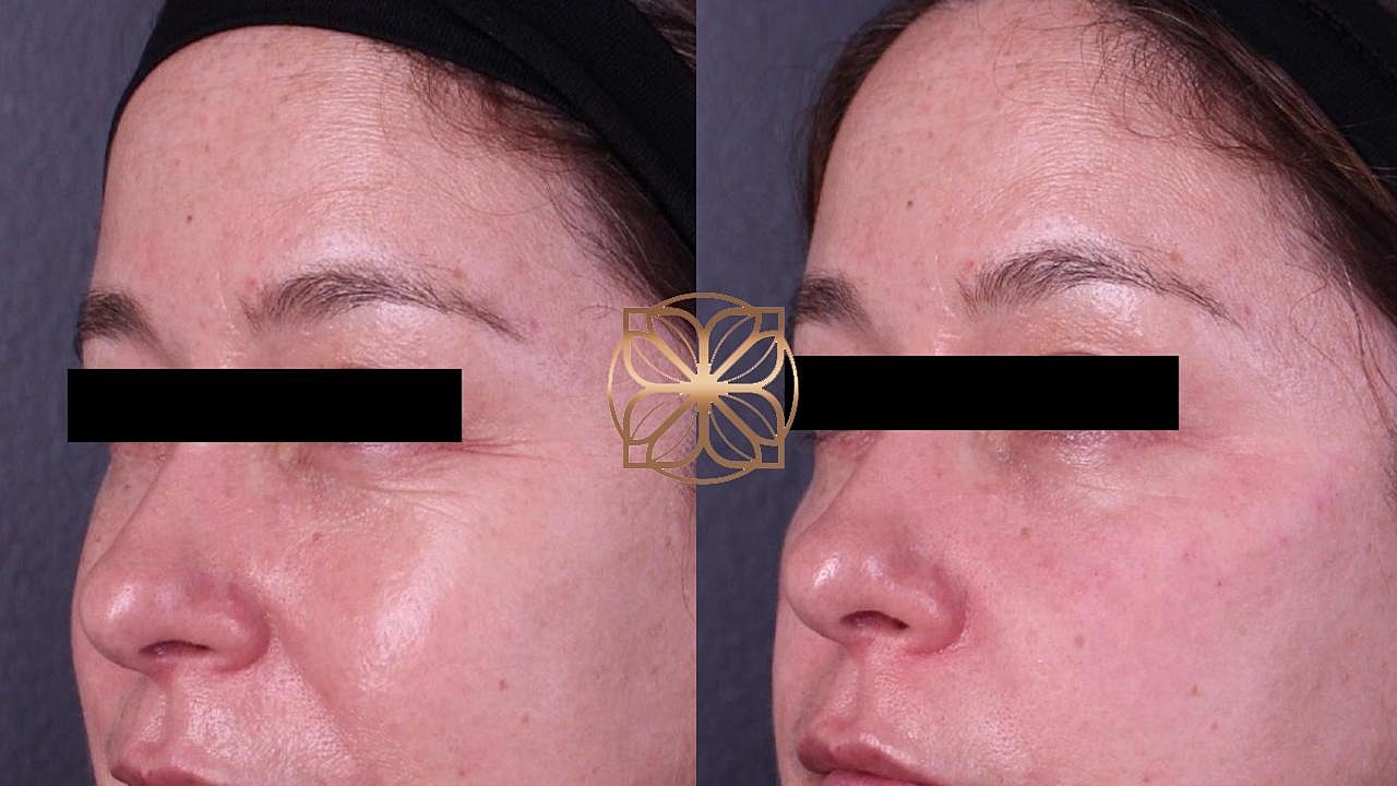 Injectables Gallery Before & After