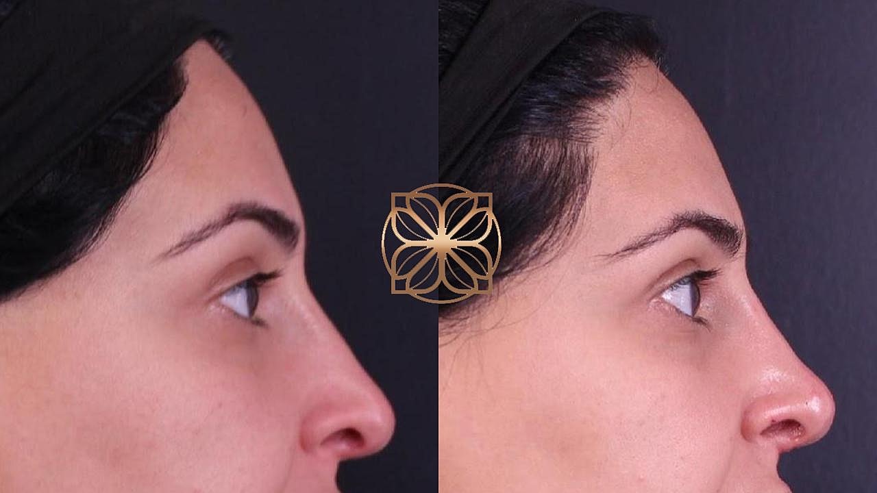 Injectables Gallery Before & After