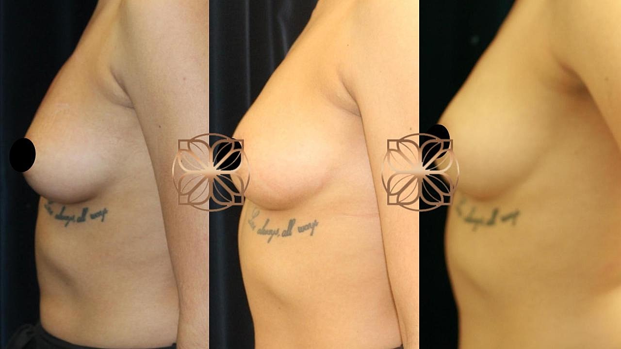 Injectables Gallery Before & After