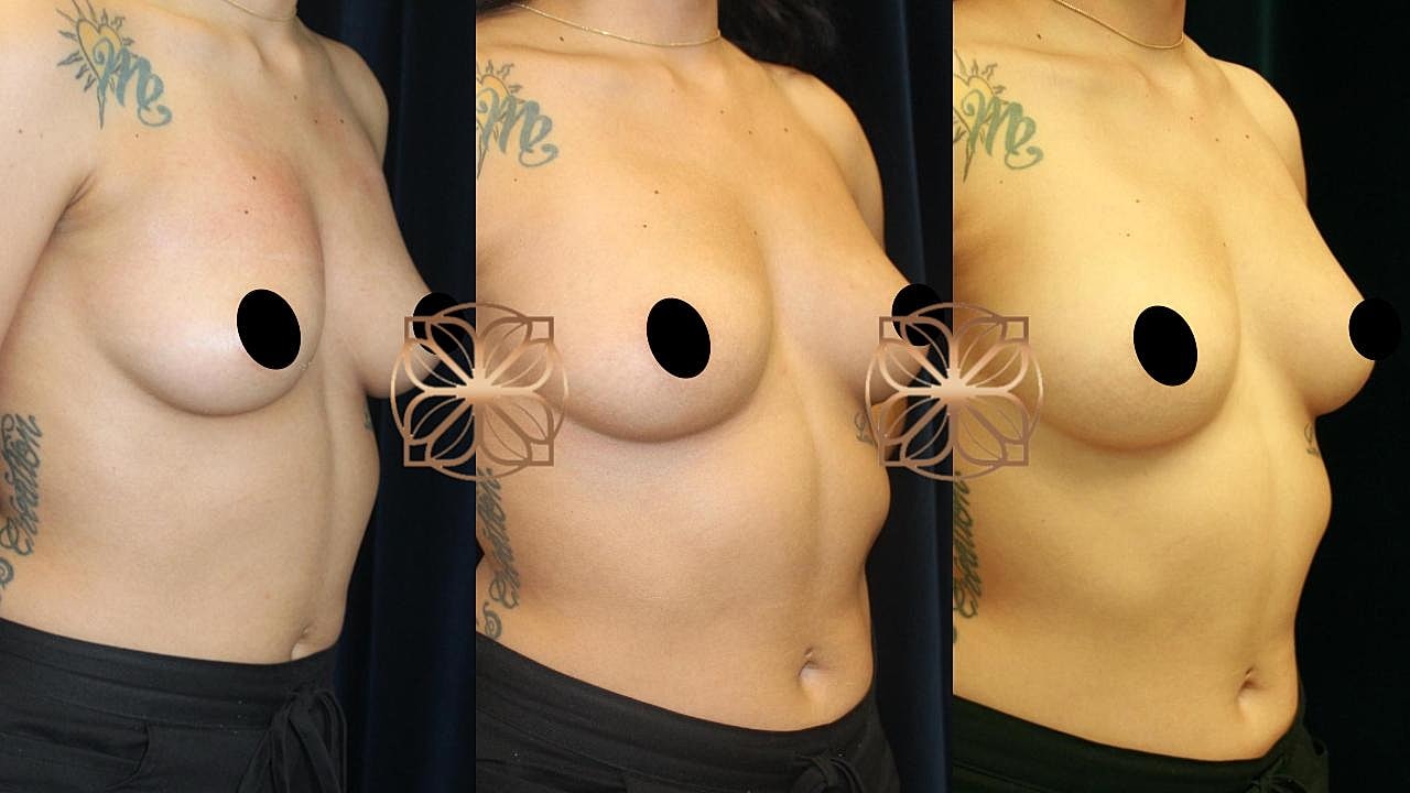 Injectables Gallery Before & After