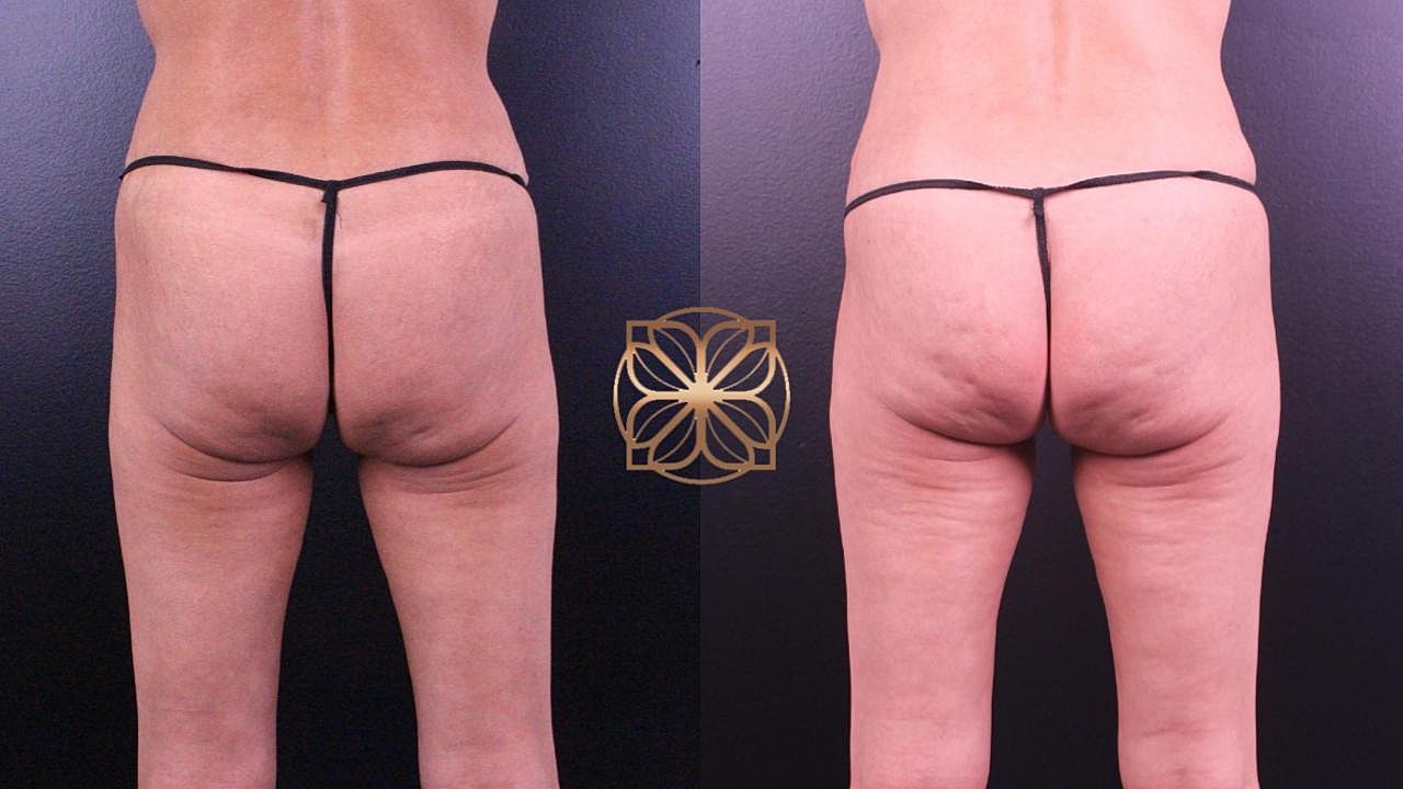 Injectables Gallery Before & After