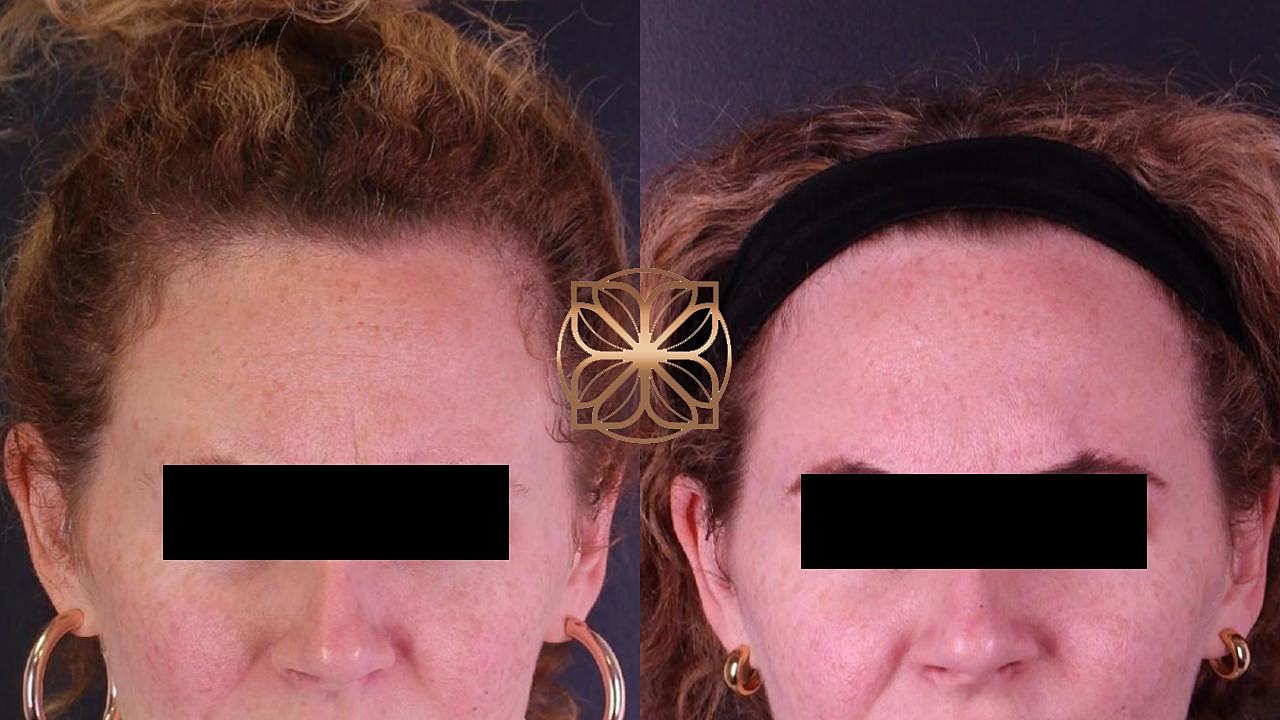 Injectables Gallery Before & After