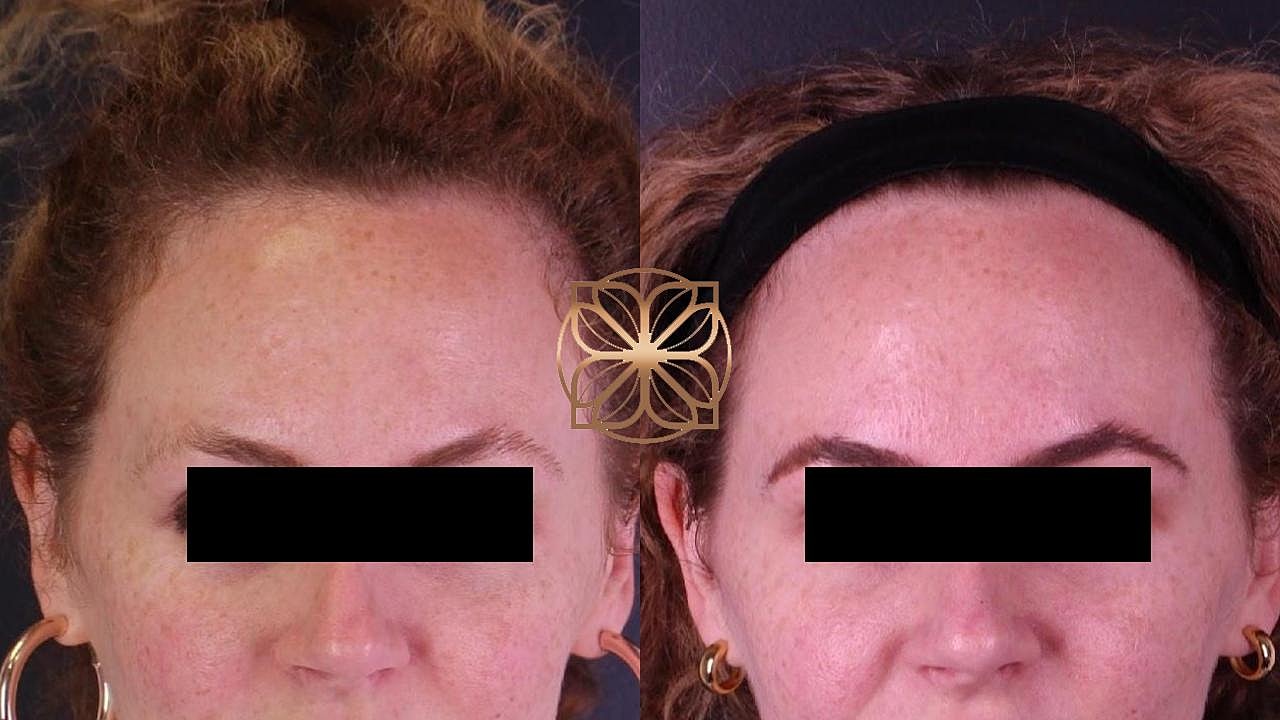 Injectables Gallery Before & After