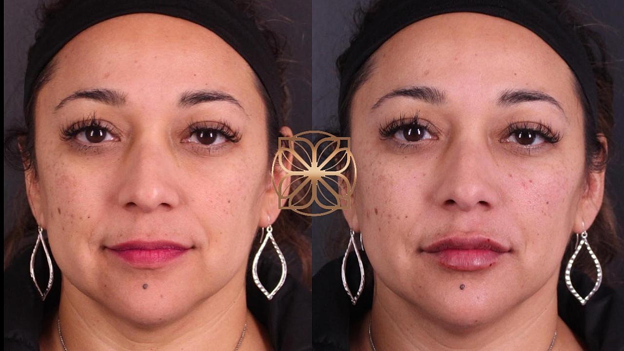 Injectables Gallery Before & After