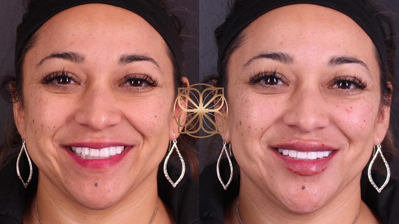 Injectables Gallery Before & After