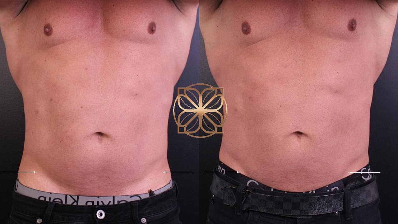 Injectables Gallery Before & After