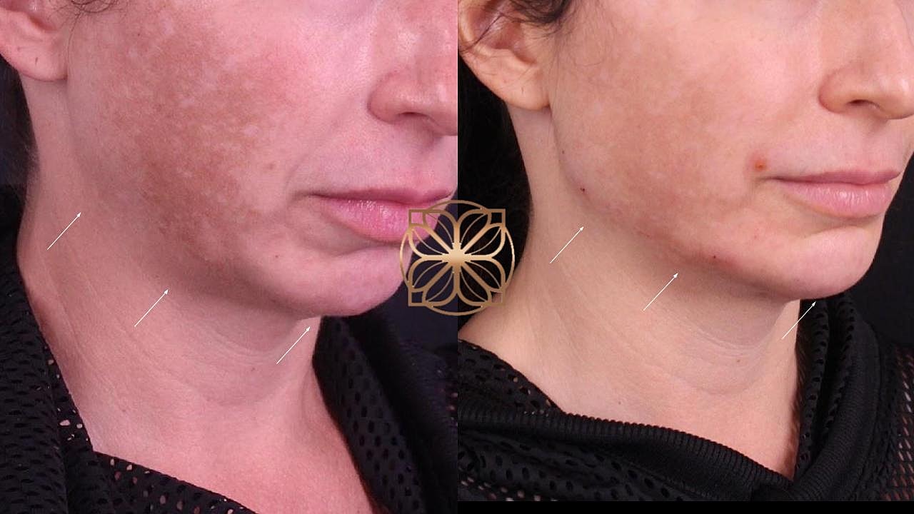 Injectables Gallery Before & After