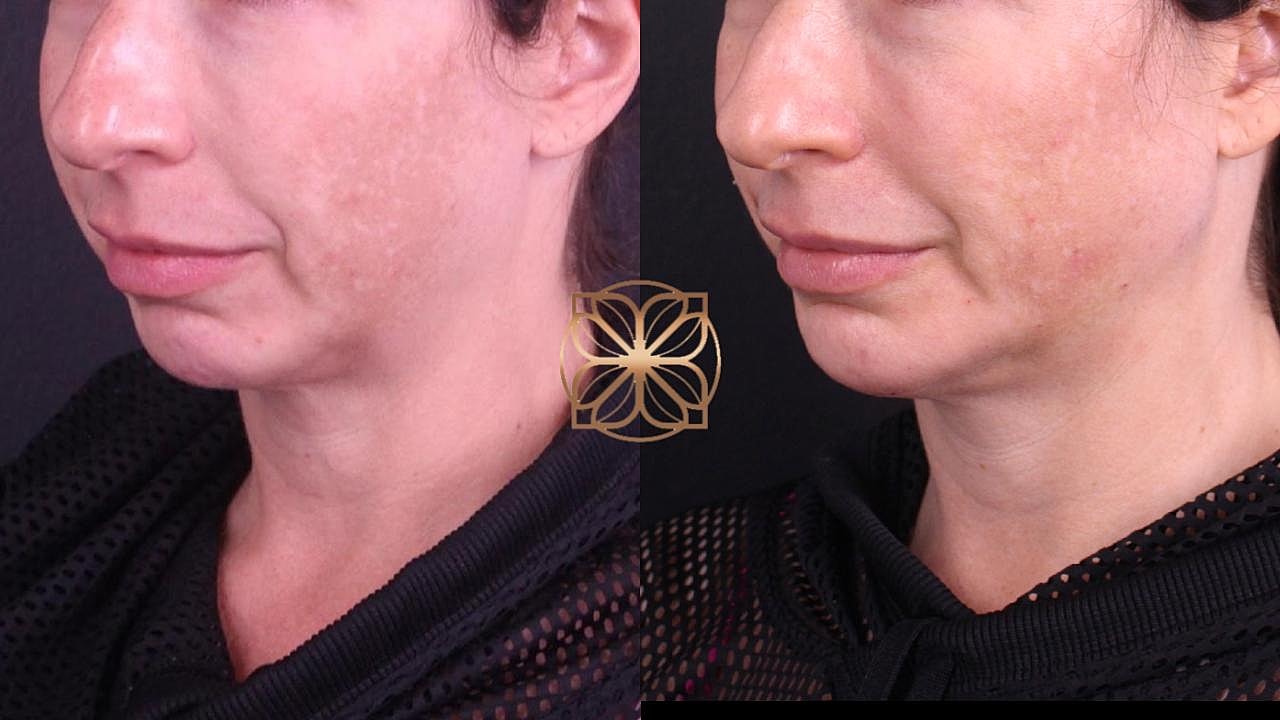 Injectables Gallery Before & After