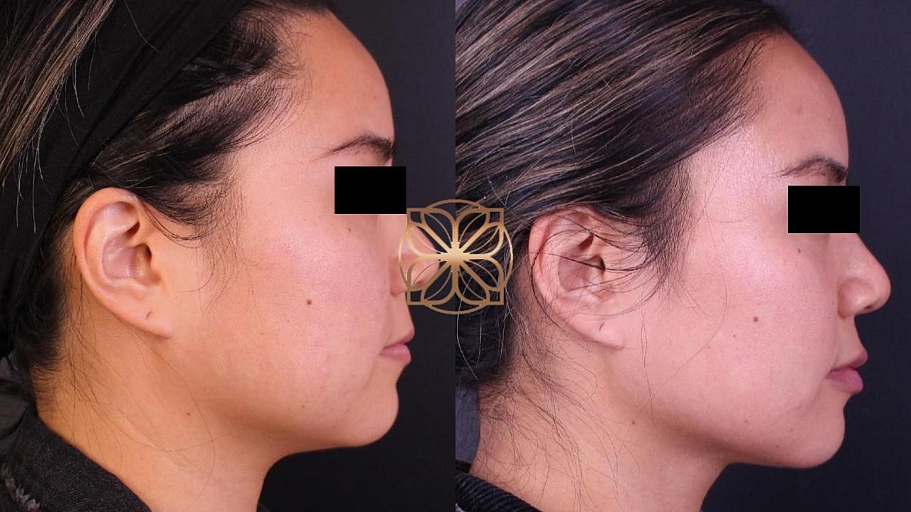 Injectables Gallery Before & After