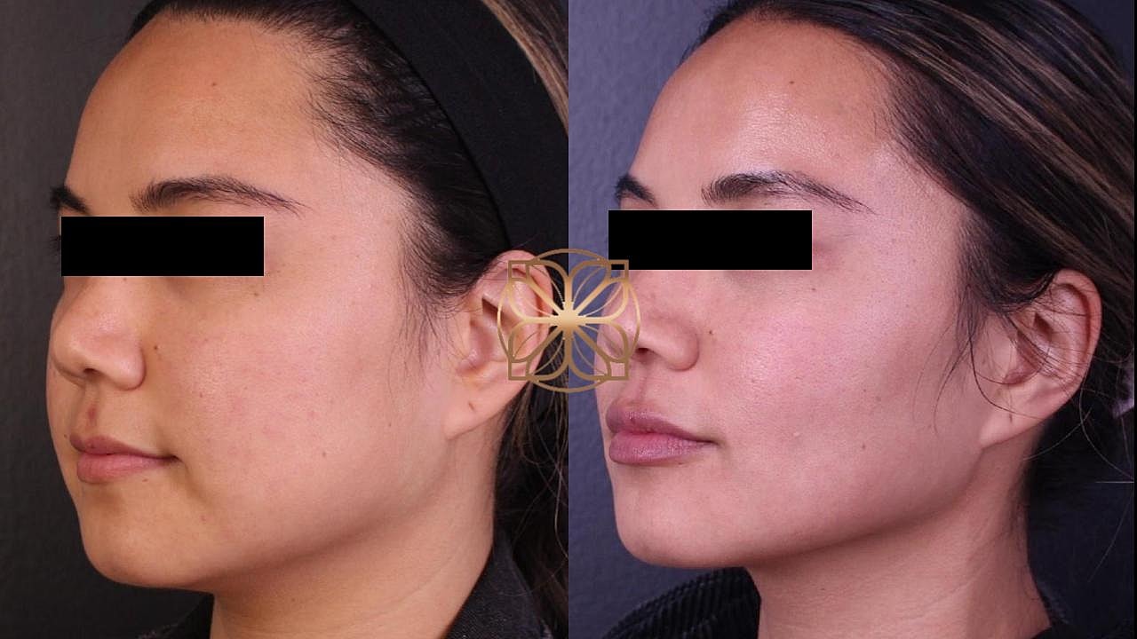 Injectables Gallery Before & After