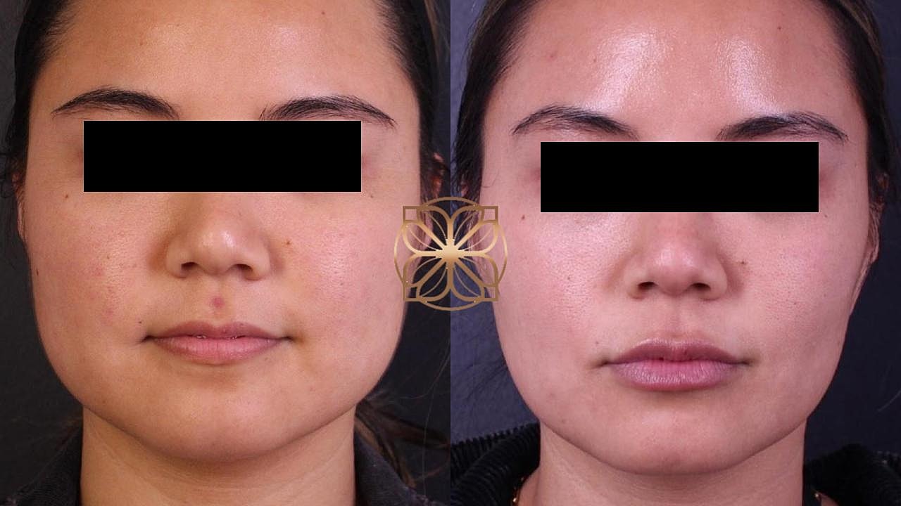 Injectables Gallery Before & After