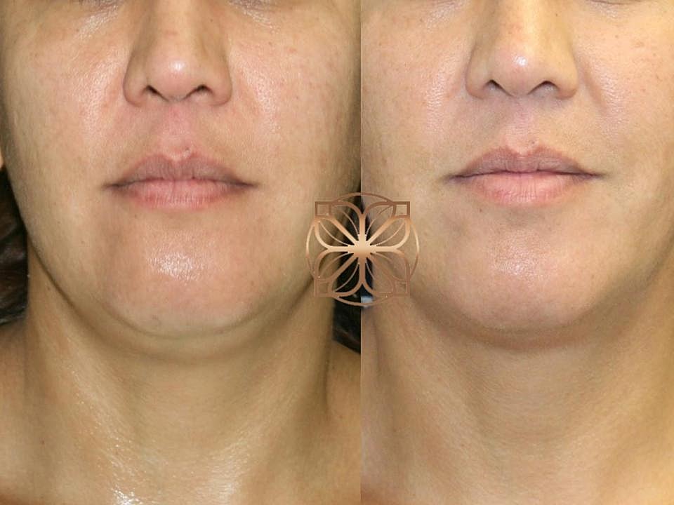 Injectables Gallery Before & After