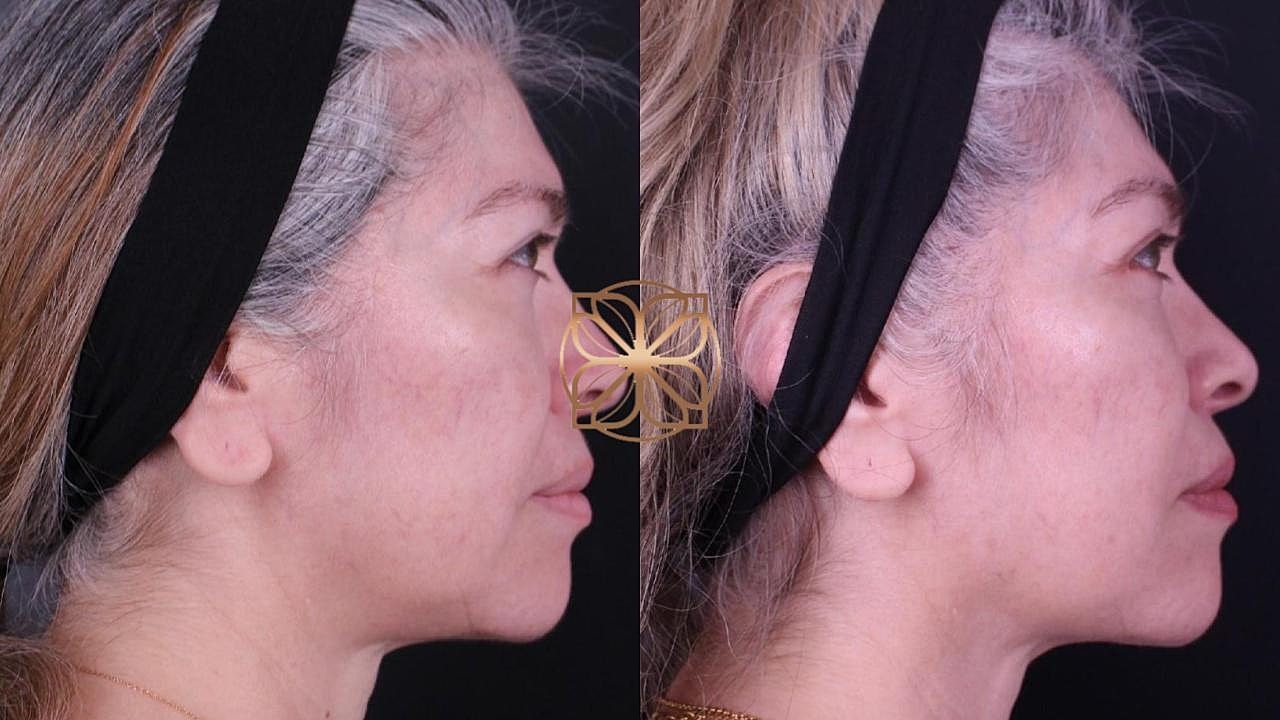 Injectables Gallery Before & After