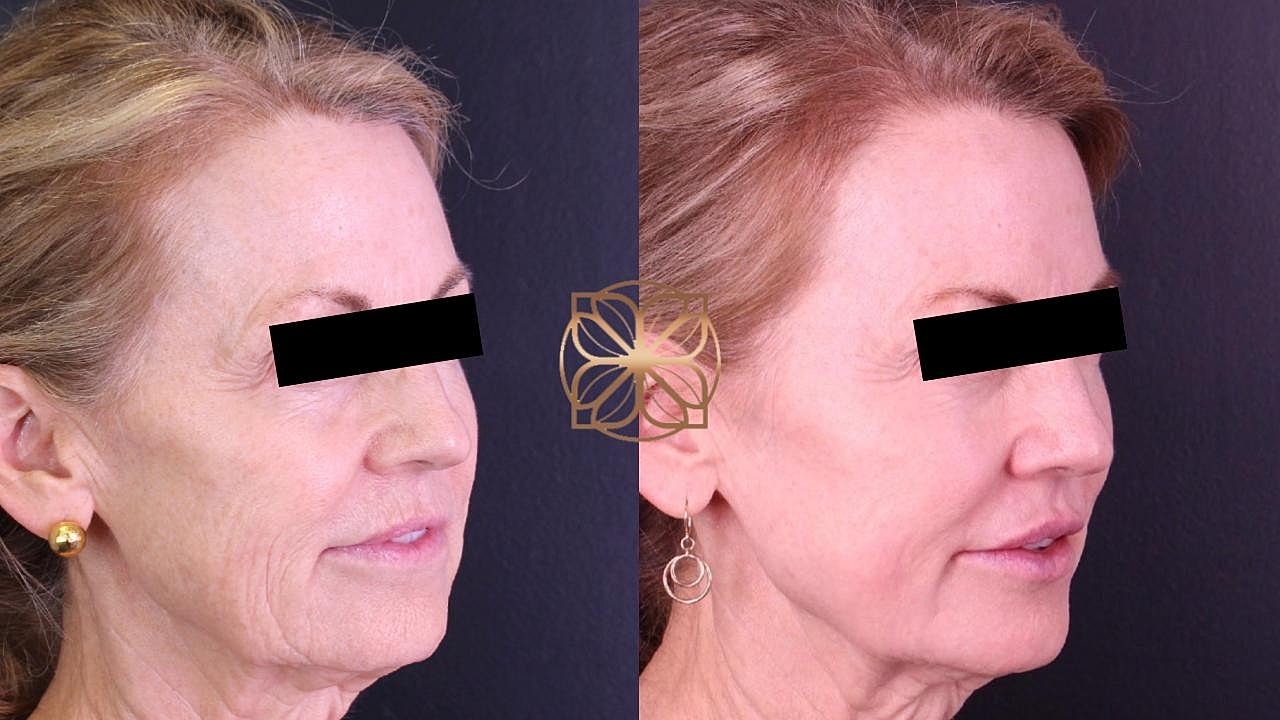 Injectables Gallery Before & After