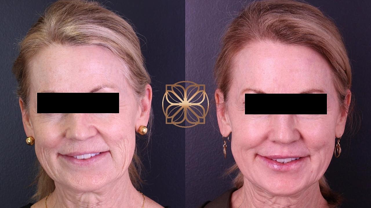 Injectables Gallery Before & After