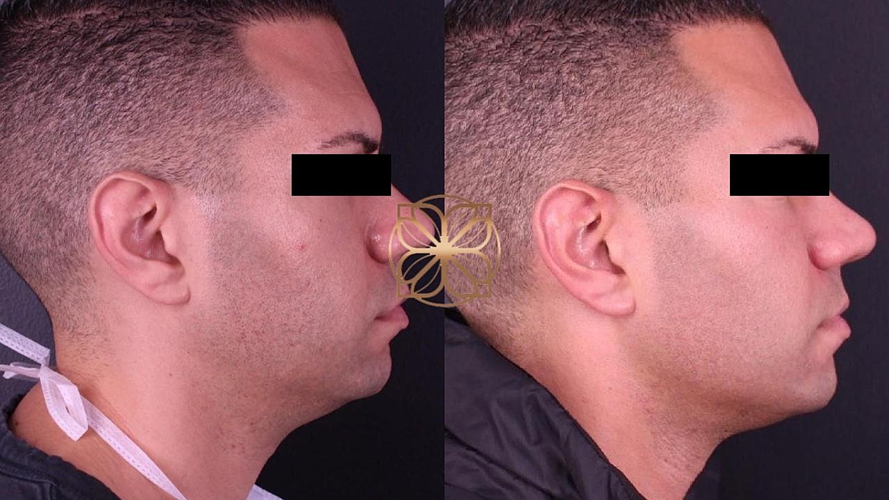 Injectables Gallery Before & After