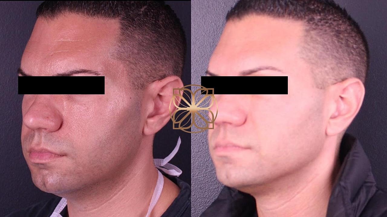 Injectables Gallery Before & After