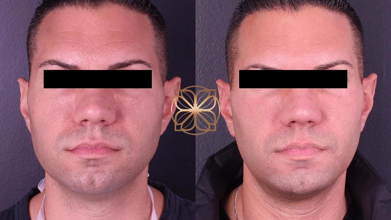 Injectables Gallery Before & After