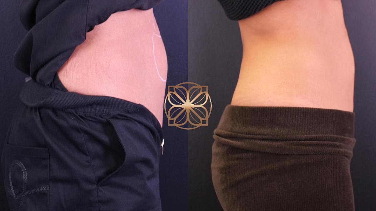 Injectables Gallery Before & After