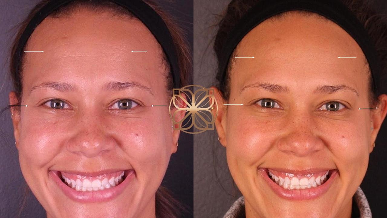 Injectables Gallery Before & After