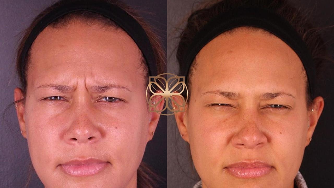 Injectables Gallery Before & After