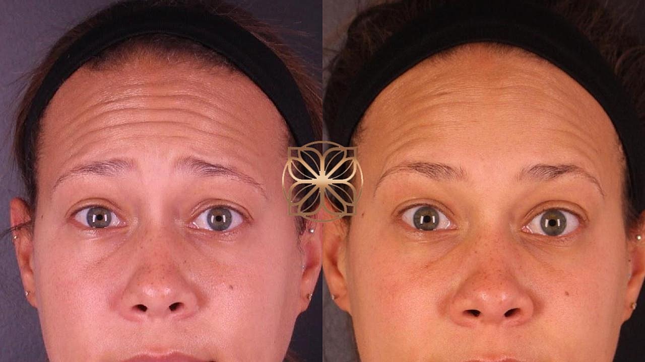 Injectables Gallery Before & After