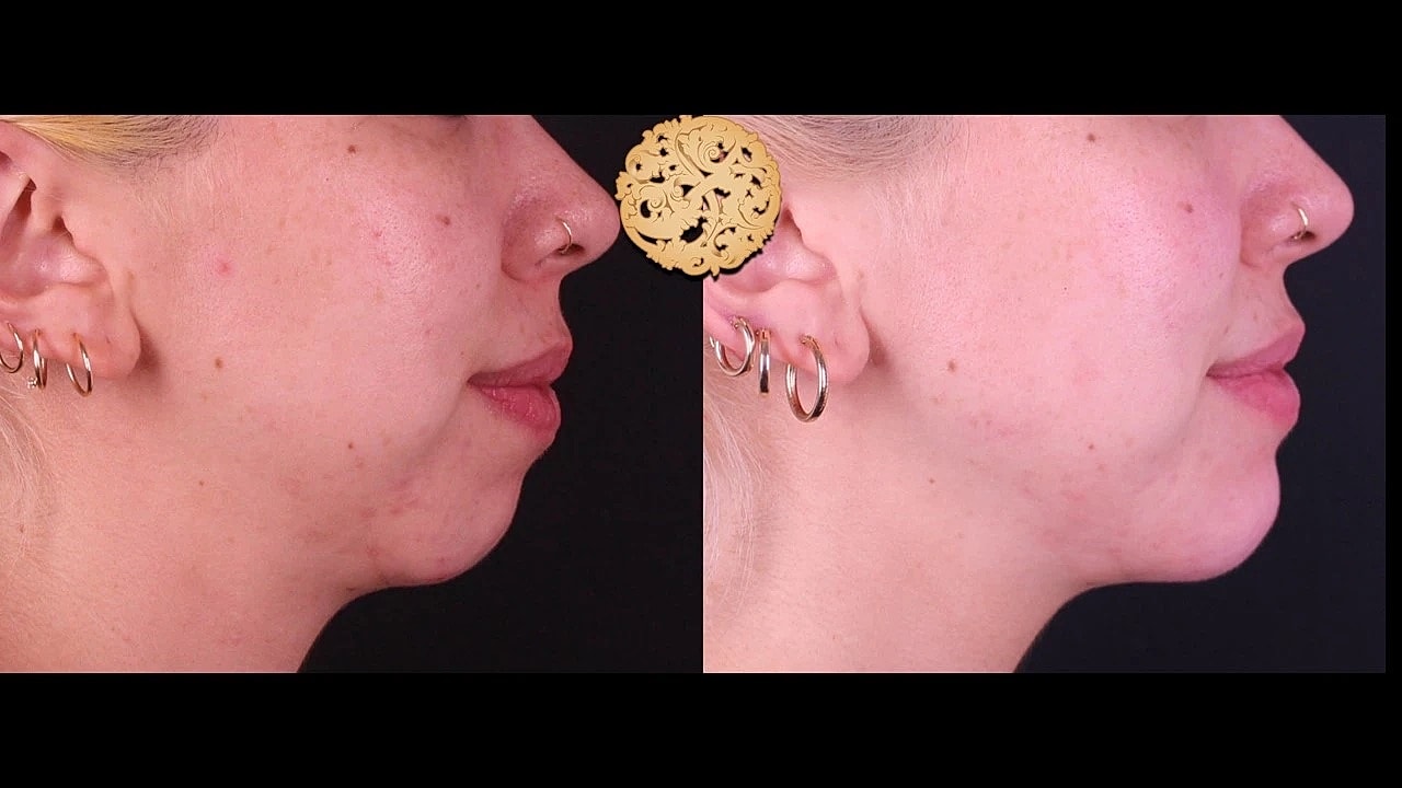 Injectables Gallery Before & After