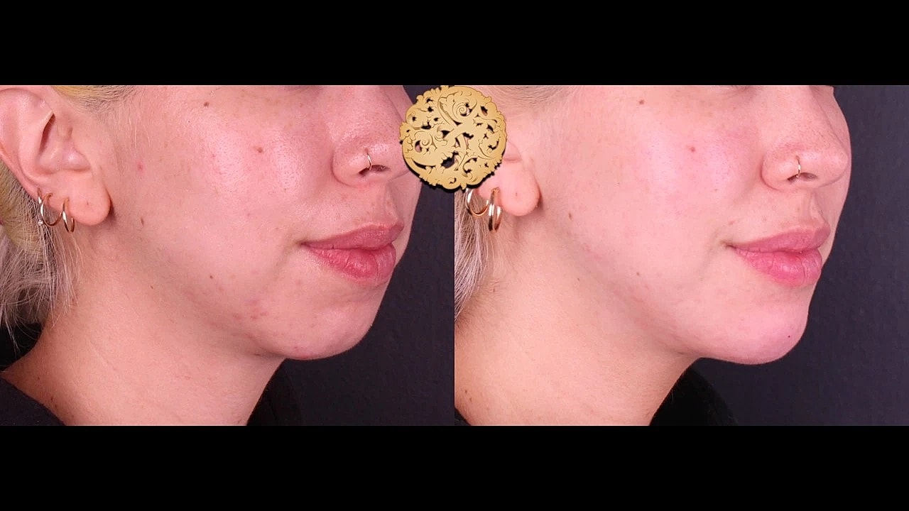 Injectables Gallery Before & After