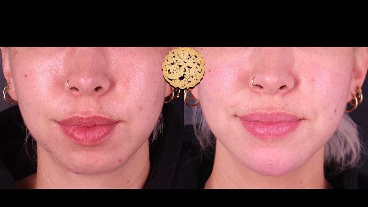 Injectables Gallery Before & After