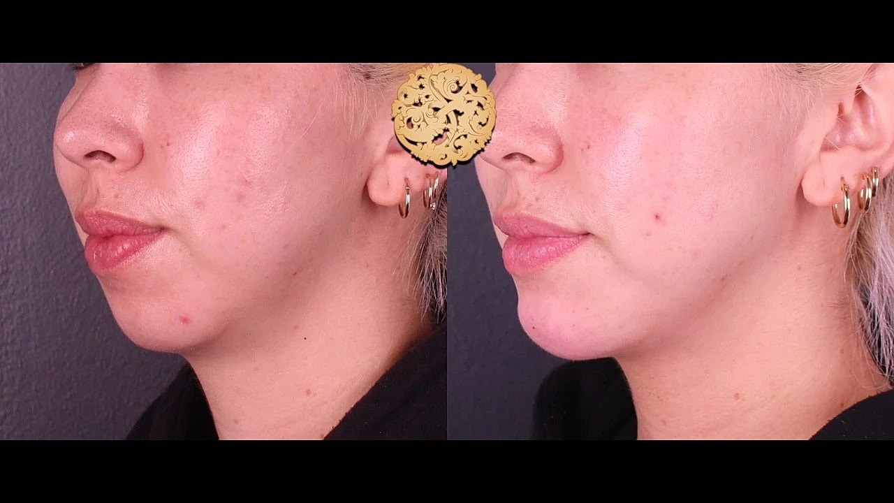 Injectables Gallery Before & After