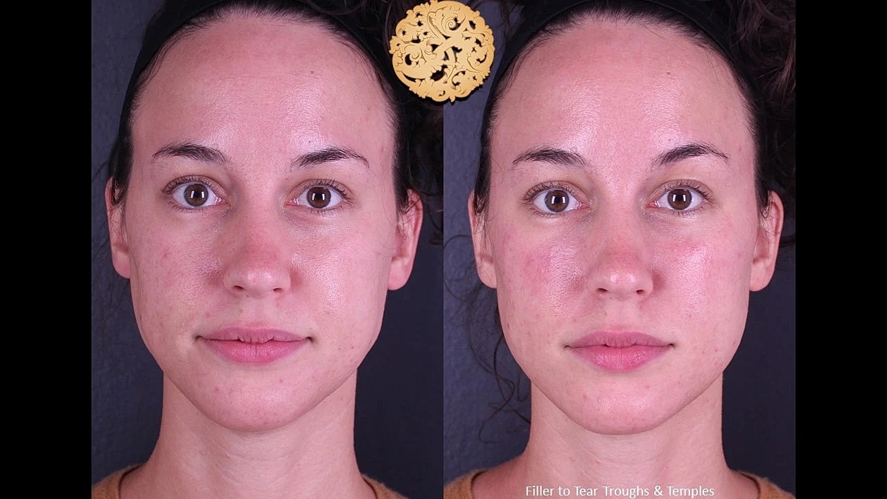 Injectables Gallery Before & After
