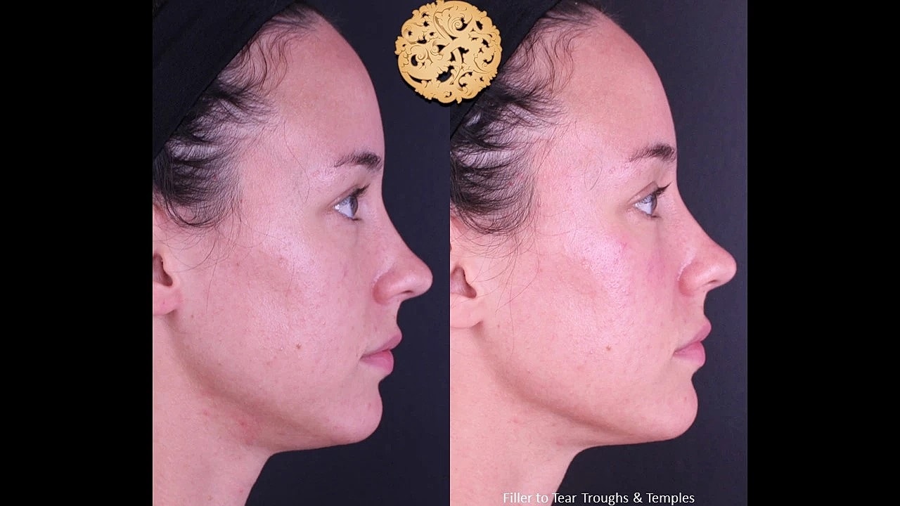 Injectables Gallery Before & After