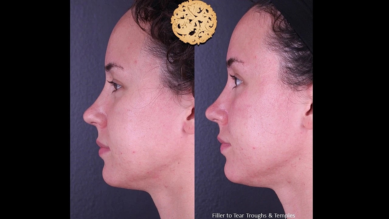 Injectables Gallery Before & After