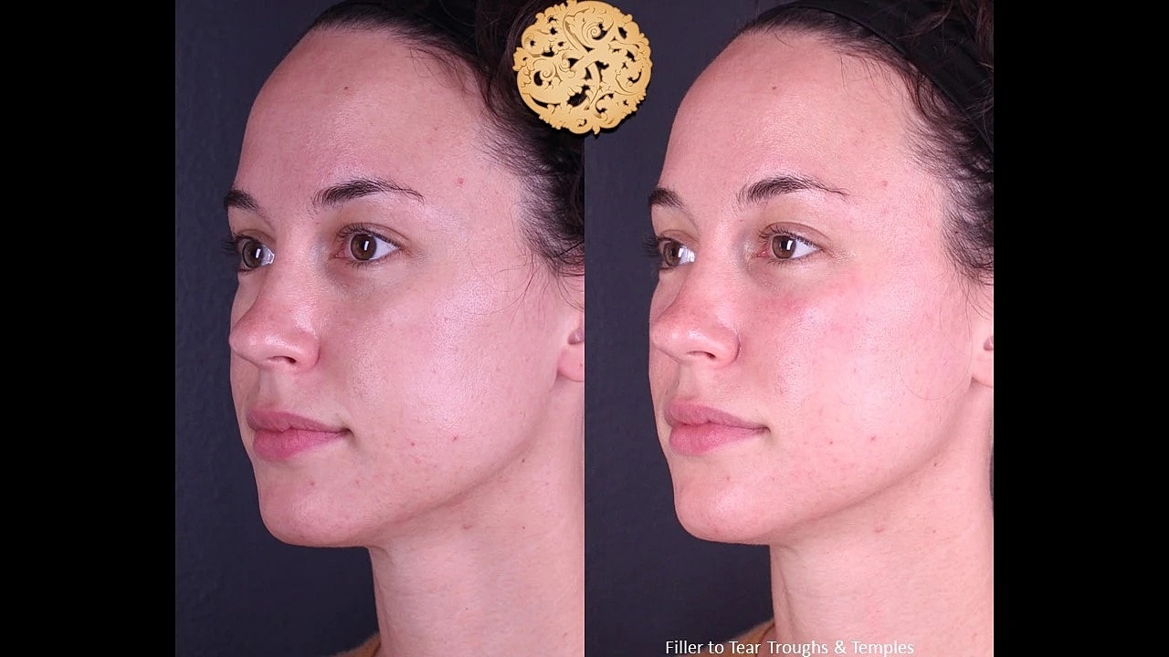 Injectables Gallery Before & After