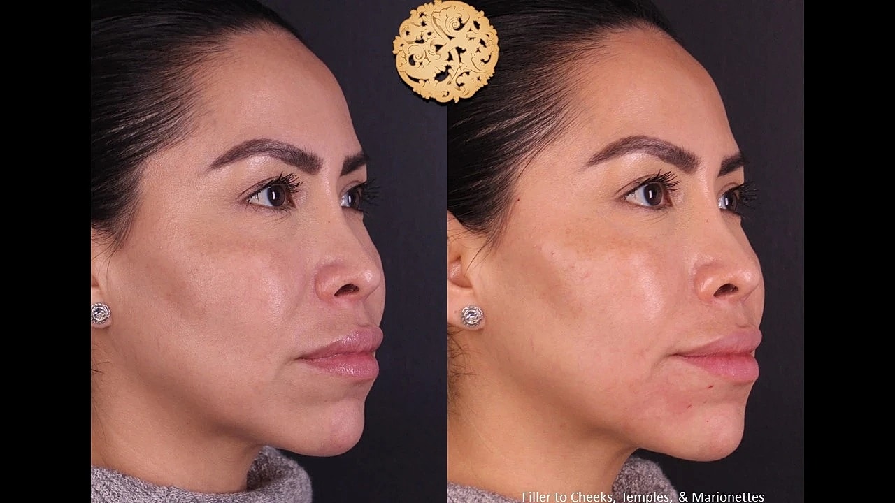 Injectables Gallery Before & After